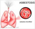 Asbestosis                                                                                                                                                                                              