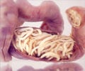 Ascariasis - Causes, Symptoms, Signs, Diagnosis, Treatment, Prevention