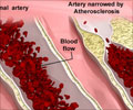 Atherosclerosis