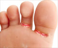 Athlete's Foot - Causes - Symptoms - Treatment - FAQs
