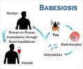 Babesiosis                                                                                                                                                                                              