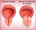Benign Prostatic Hyperplasia (BPH) Causes Symptoms Diagnosis Treatment FAQs