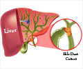 Bile Duct Cancer | Cholangiocarcinoma - Causes, Risk Factors, Symptoms, Diagnosis, Stages, Treatment, Support Groups Bile Duct Cancer | Cholangiocarcinoma - Causes, Risk Factors, Symptoms, Diagnosis, Stages, Treatment, Support Groups