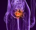 Bladder Cancer – Symptoms, Signs, Diagnosis, Treatment, Prognosis & Prevention