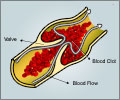 Blood Clots                                                                                                                                                                                             