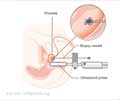 Brachytherapy for Prostate Cancer Brachytherapy for Prostate Cancer