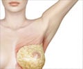 Breast Cancer Management: Advances