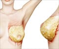 About Breast Reduction Surgery