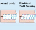 Bruxism - Incidence Causes Diagnosis Treatment Prevention FAQs