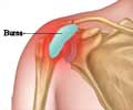 Bursitis Shoulder | Bursitis Shoulder Bursitis Shoulder | Bursitis Shoulder