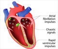 Cardiac Ablation