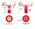 Cervical Cancer - Types, Causes, Symptoms, Diagnosis, Treatment, Complications & Prevention
