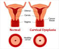 Cervical Dysplasia Cervical Dysplasia