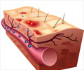 Chickenpox (Varicella) - Symptom Evaluation Chickenpox (Varicella) - Symptom Evaluation