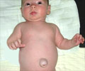 Child-Hernia, Hydrocele Child-Hernia, Hydrocele