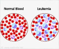 Chronic Lymphocytic Leukemia Chronic Lymphocytic Leukemia