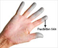 Cold Weather Injuries - Tissue Freezing, Prevention