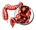 Colorectal Cancer