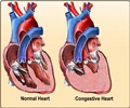Congestive Heart Failure (Congestive Cardiac Failure) Current Management 