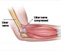 Cubital Tunnel Syndrome | Ulnar Neuropathy | Cell Phone Elbow Cubital Tunnel Syndrome | Ulnar Neuropathy | Cell Phone Elbow