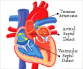 Cyanotic Heart Disease - Causes, Symptoms, Diagnosis, Treatment