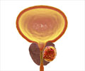 Drugs for Prostate Cancer                                                                                                                                                                               