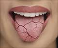 Dry Mouth - Causes, Symptoms, Diagnosis, Treatment & Prevention