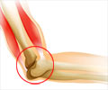 Elbow Dislocation - Causes, Symptoms, Diagnosis, Treatment