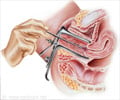 Endometrial Biopsy