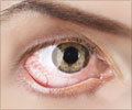 Eye Pain - Symptom Evaluation