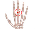Fracture of Finger | Broken Finger - Types, Causes, Symptoms, Diagnosis, Treatment