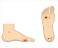 Foot Ulcer - Causes, Types, Symptoms, Treatment & Prevention Foot Ulcer - Causes, Types, Symptoms, Treatment & Prevention