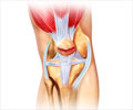 Fracture of Knee Cap - Causes - Symptoms - Diagnosis - Treatment - FAQs