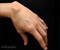 Ganglion Cysts - Ganglion Wrist                                                                                                                                                                         