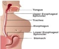 Gastroesophageal Reflux Disease (GERD) Gastroesophageal Reflux Disease (GERD)