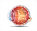 Glaucoma - Causes, Symptoms, Diagnosis, Treatment & Prevention