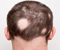 Hair Loss - Symptom Evaluation