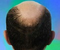 Top Tips for Hair Loss Prevention/How to Stop Hair Fall 