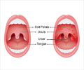 Herpangina (Painful Mouth Infection) - Causes, Symptoms, Diagnosis, Treatment, Prevention