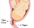 Incompetent Cervix                                                                                                                                                                                      