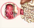 Inflammatory Bowel Disease                                                                                                                                                                              