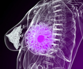 Inflammatory Breast Cancer Inflammatory Breast Cancer
