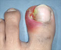Ingrown Toe Nails