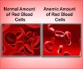 Iron Deficiency Anemia
