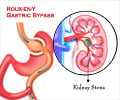 Why are Kidney Stones Common after Bariatric Surgery?