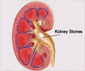 Kidney Stones / Renal Stones - Causes - Symptoms - Diagnosis - Treatment - FAQs Kidney Stones / Renal Stones - Causes - Symptoms - Diagnosis - Treatment - FAQs