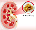 Kidney Stone Prevention - Types, Treatment