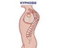 Kyphosis                                                                                                                                                                                                