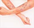 Lichen planus - Causes, Diagnosis, Complications, Treatment & Prevention
