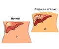 Alcoholic Liver Disease                                                                                                                                                                                 